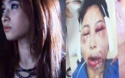 Người mẫu Thái trẻ đẹp mặt méo lệch vì phẫu thuật hỏng