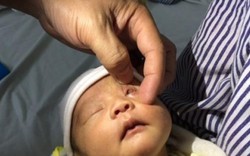 Bé gái 15 ngày tuổi bị loét giác mạc do mẹ nhỏ sữa vào mắt