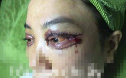 Cư dân mạng sốc nặng trước ảnh cắt mí hỏng của cô gái Việt