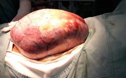 Bóc tách khối u buồng trứng khổng lồ trong bụng cô gái 21 tuổi