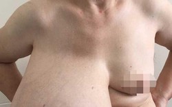 Phát hoảng với ngực khổng lồ, dài đến rốn của một phụ nữ ở Thái Nguyên
