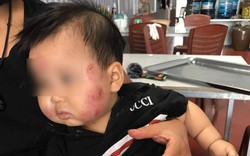 Bắc Giang: Bé một tuổi bầm tím đầy người khi đi gửi trẻ