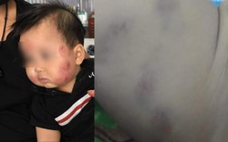 Bắc Giang: Thông tin mới vụ bé 1 tuổi bầm tím vì "mặc bỉm quá chật"