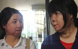 2 cô gái bị chồng đốt tựa vào nhau tìm lại hình hài