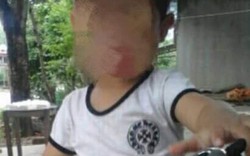 Bé trai 5 tuổi ở Yên Bái tử vong bất thường sau khi gây mê cắt amidan