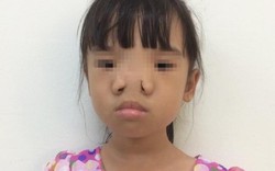 Chữa trị thành công cho bé gái có khuôn mặt dị thường hiếm gặp