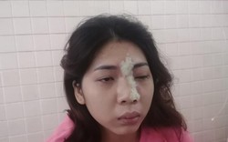 Cô gái 21 tuổi mù mắt trái sau khi tiêm filler nâng mũi