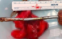 Mỹ: Đau đớn dữ dội suốt một tuần, phát hiện tuốc nơ vít dài 21cm trong cơ thể