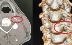 Nhập viện vì uống "nước thần" thầy mo chữa hóc xương cá