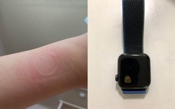 Apple Watch quá nhiệt gây bỏng tay người dùng