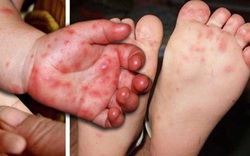 Đắk Lắk‎: Hơn 700 trường hợp mắc bệnh tay chân miệng