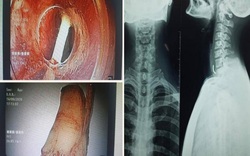 Nhập viện cấp cứu vì bị hóc xương khi ăn bún giò