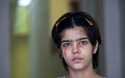 Giải mã bí ẩn của haemolacria: "Chứng bệnh" khiến những cô gái Ấn Độ khóc ra máu