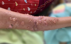 Bé gái 8 tuổi bị sứa cắn phải nhập viện