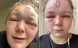 Phơi nắng suốt 2 tiếng, cô gái trẻ bị mù tạm thời vì ngộ độc ánh nắng mặt trời