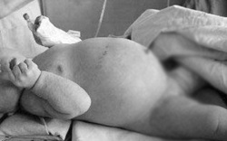 Hy hữu: Phẫu thuật khẩn cho bé gái 1 ngày tuổi bị "thai trong thai" hiếm gặp
