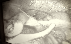 Cà Mau: Xương cá xuyên thủng ruột thừa