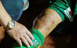 Cầu thủ Sài Gòn FC bị đạp móp đầu gối, người tung chân vô tội?! 