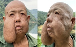 Lai Châu: Người đàn ông với khối u kì dị trên mặt
