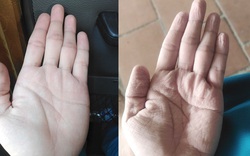 Những đôi bàn tay "biến dạng" tại tâm dịch Covid-19 