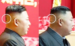 Kim Jong-un xuất hiện với vết bầm lớn sau đầu, khiến giới tình báo bối rối