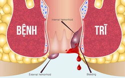 Bệnh trĩ được phân loại, sẽ giúp điều trị hiệu quả