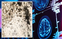 Bác sĩ sốc khi phát hiện ra nấm đen trong não người đàn ông, không tin được rằng bệnh nhân còn sống