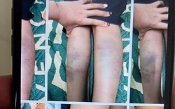 Vụ học sinh bị đánh bầm tím tay chân: Phân công giáo viên dạy thay cô giáo chủ nhiệm