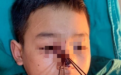 Nghệ An: Cấp cứu bé trai với chi chít mũi tên ghim vào mặt