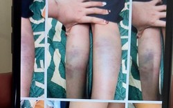 Vụ học sinh bị đánh bầm tím tay chân: Vì sao không khởi tố?
