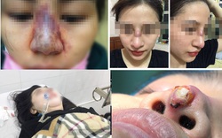 Vụ cô gái 22 tuổi tử vong vì nâng mũi: Những biến chứng nguy hiểm khi phẫu thuật nâng mũi