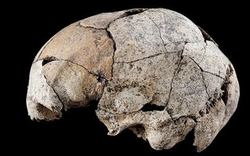 Hộp sọ cổ đại cho thấy bằng chứng về ca phẫu thuật tai đầu tiên của loài người
