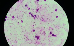 TP.HCM xuất hiện 2 ca sốt rét đầu tiên từ châu Phi