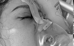 Cô gái bị mù mắt phải sau khi tiêm filler nâng mũi tại Đà Nẵng