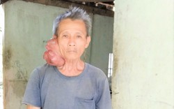 Báo NTNN/Dân Việt và nhà hảo tâm hỗ trợ cụ ông mang khối u nặng 2kg ở cổ
