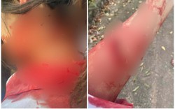 Hà Nam: Xích mích trên mạng xã hội, một nữ sinh bị chém gây thương tích
