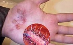 Một nữ bệnh nhân ở Quảng Nam tử vong do mắc bệnh "vi khuẩn ăn thịt người" whitmore