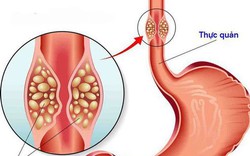 Đau rát họng, nuốt khó tưởng viêm họng hóa ra ung thư thực quản