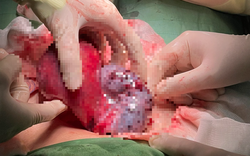 Phẫu thuật thành công u buồng trứng biến chứng nguy hiểm cho bệnh nhi 15 tuổi