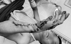 Phẫu thuật khẩn trong đêm cứu cánh tay bị máy cưa nghiền nát