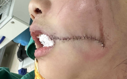 Bị thang máy chở đồ va vào mặt, bé gái 7 tuổi rách toạc miệng, vỡ xương ổ răng
