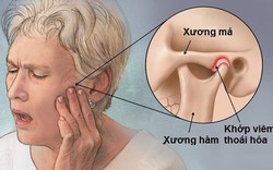 Cử động hàm có tiếng động lục cục, coi chừng viêm khớp xương hàm