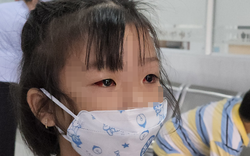 Đau mắt đỏ bùng phát ở TP.HCM, người dân làm gì để phòng tránh?