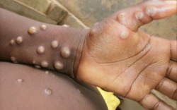 Chuyên gia y tế đánh giá nguy cơ lây nhiễm bệnh đậu mùa khỉ hiện nay