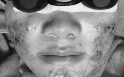 Nữ sinh biến dạng da mặt sau khi dùng rượu thuốc không nhãn mác ở spa người quen