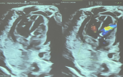 Can thiệp xuyên tử cung cứu sống bào thai 29 tuần tuổi bị tim bẩm sinh rất nặng