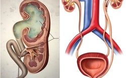 Bất ngờ với bệnh nhân có 3 quả thận, 3 niệu quản