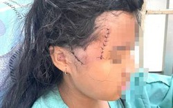 Bé gái nghi bị cha dượng bạo hành