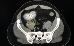 Thanh niên bị viêm ruột thừa kích thước lớn hiếm gặp