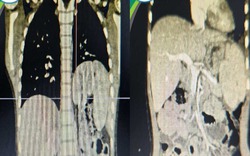 Ca bệnh hiếm: Thận "lạc" lên ngực, phổi biệt lập, thoát vị hoành bẩm sinh